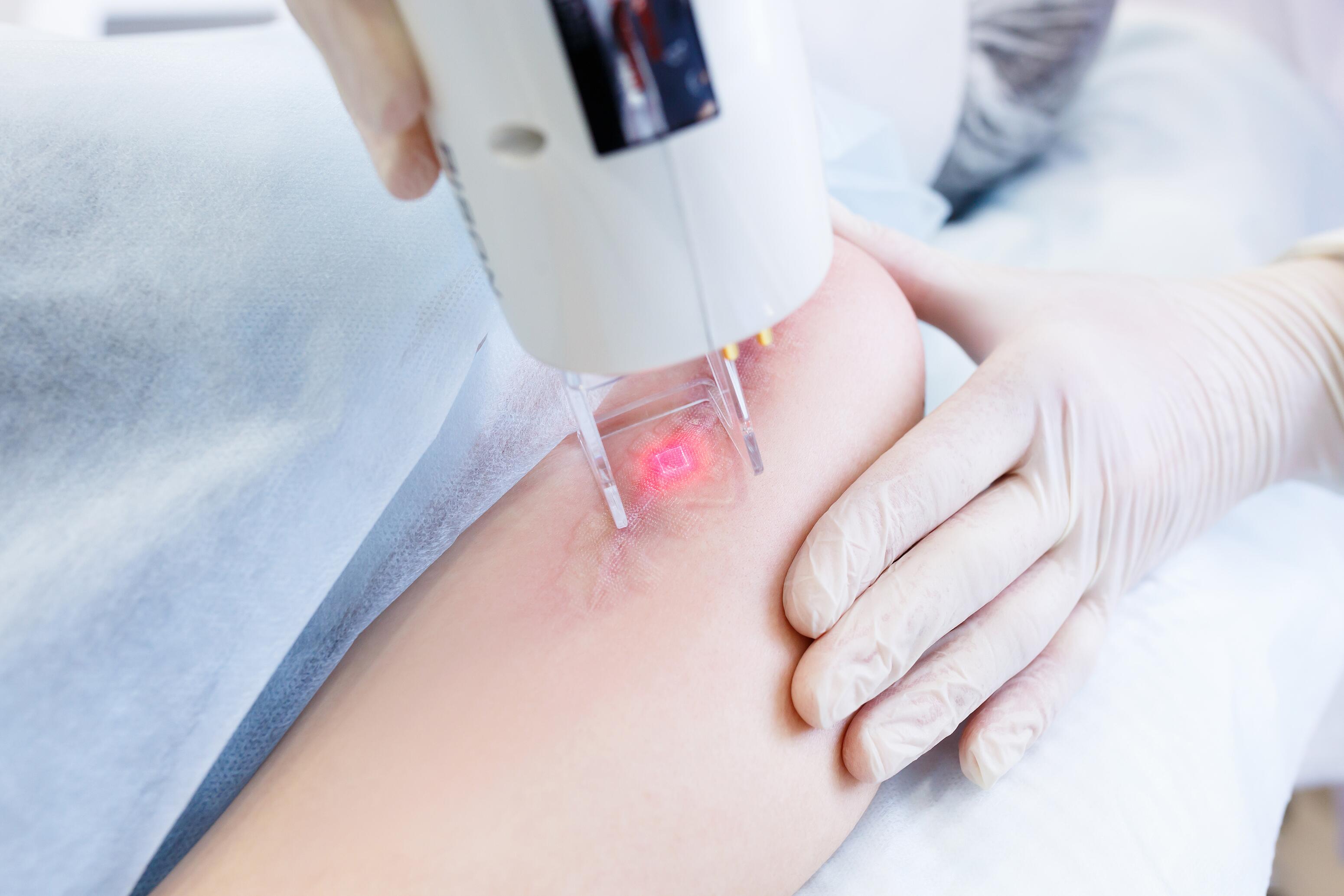 Chirurgie esthétique et traitement au laser cicatrice hypertrophique